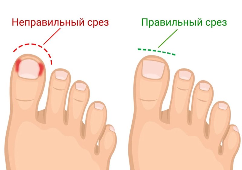 КПК правильно стрич ногти НП ногах