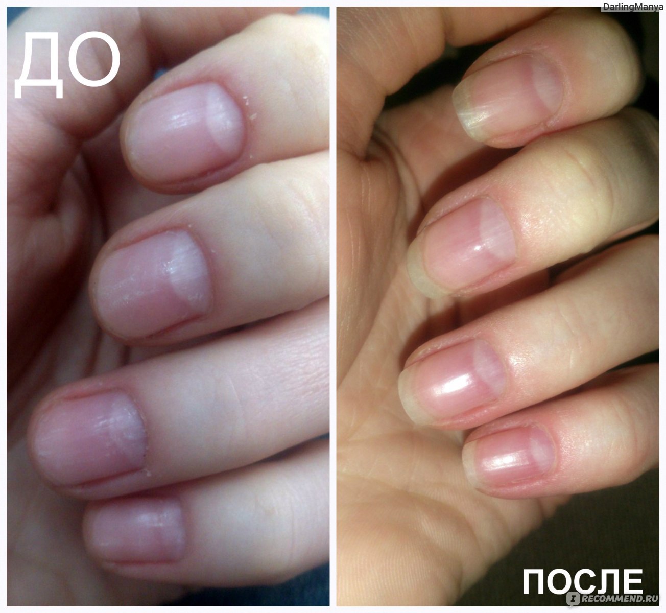 Почему ногти растут медленно. Маникюр до и после. Отрастить ногти. Ногти до и после маникюра. Маникюр до и после отросшие ногти.