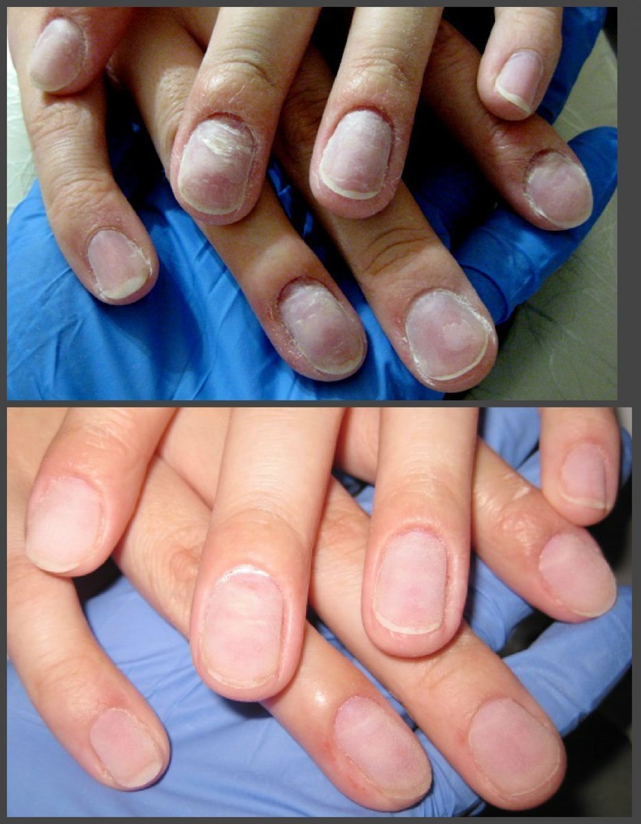 Онихолизис можно покрыть гелем. Маникюр на грызанные ногти.