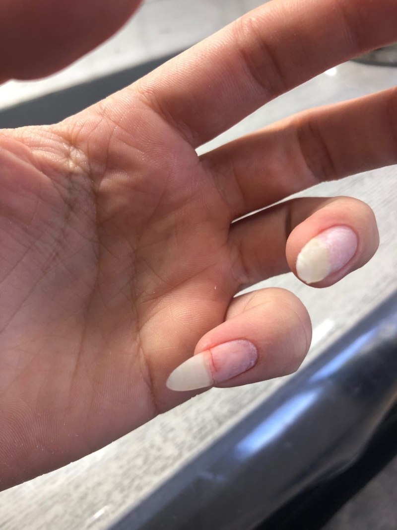 Сломанные ногти нарощенные