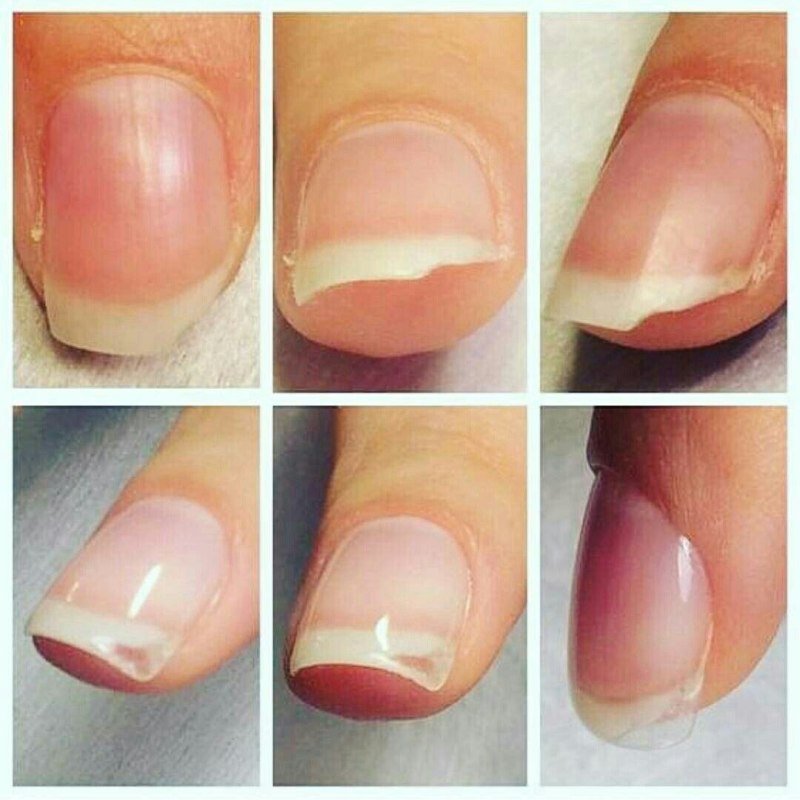 Отросшие ногти