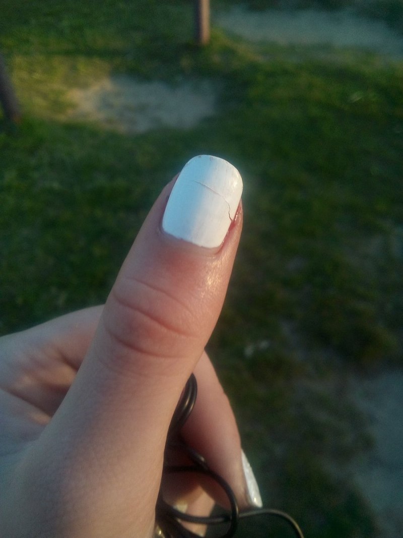 Боковой онихолизис ногтей