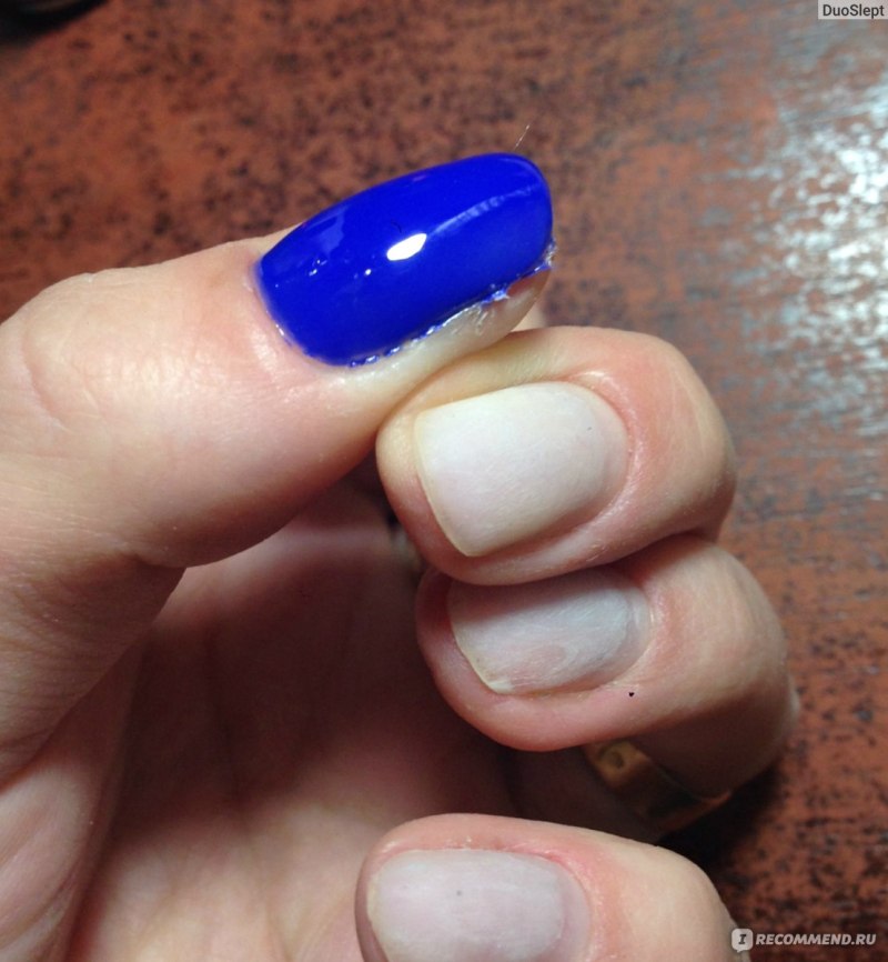 Травматичный онихолизис