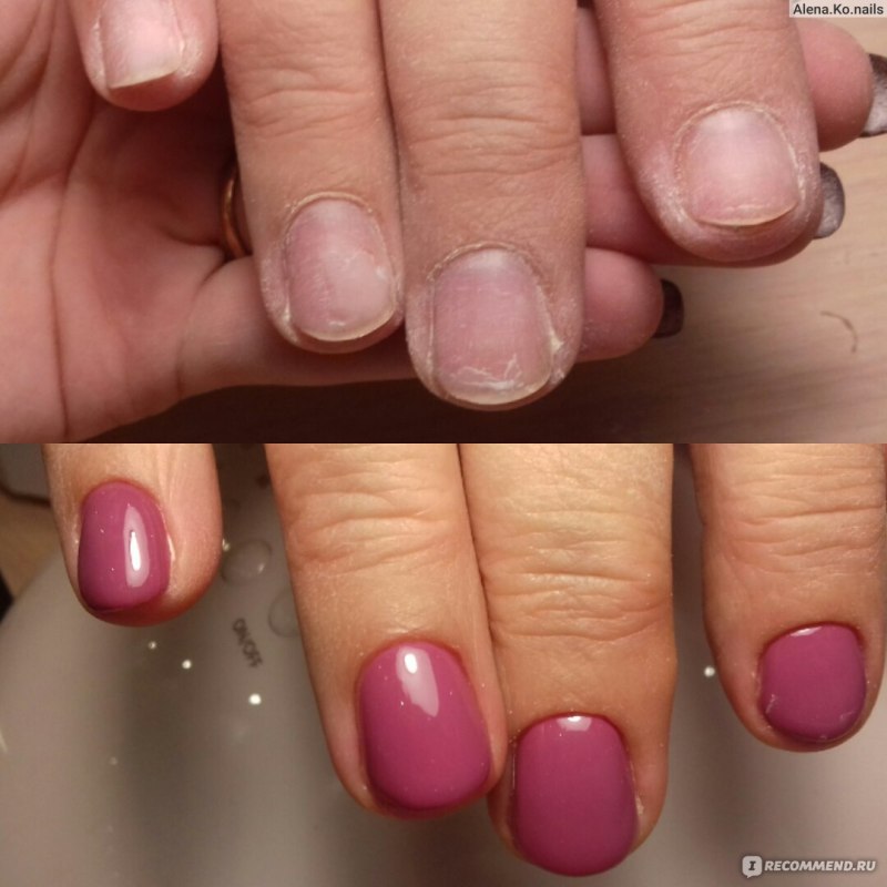 Ногти после тесной обуви