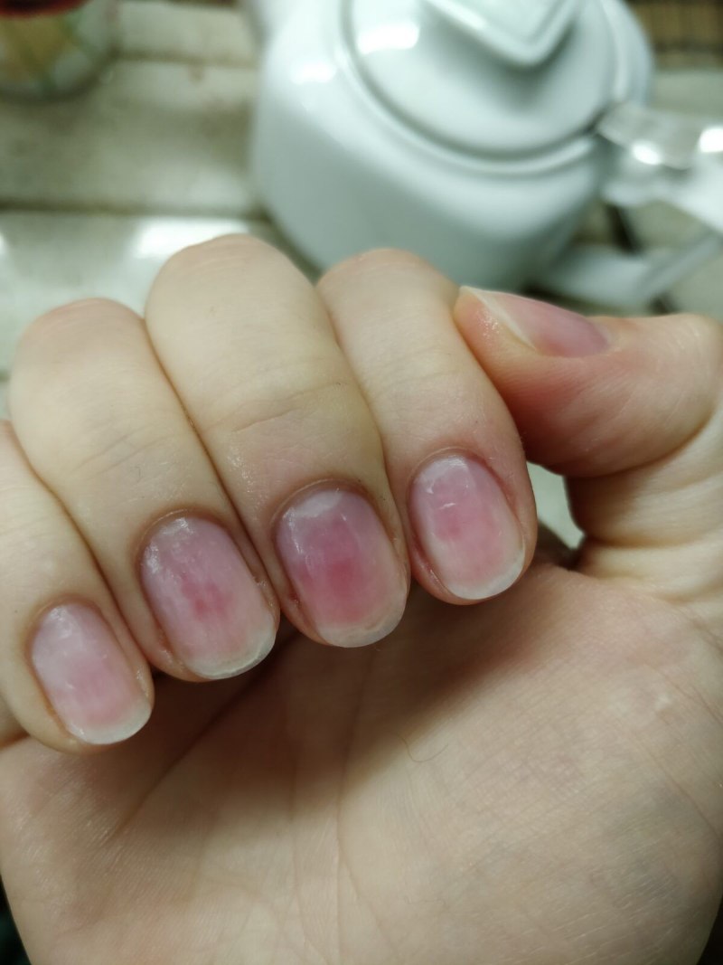 Пузырьки на ногтях под лаком