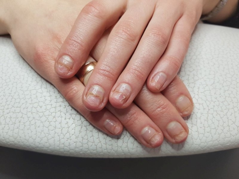 Лечебный маникюр