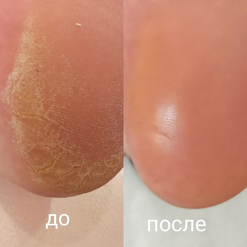 Гладкие пятки до и после
