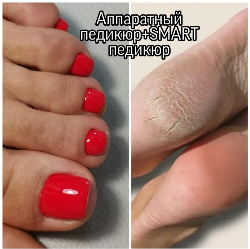 Препаратный педикюр до и после
