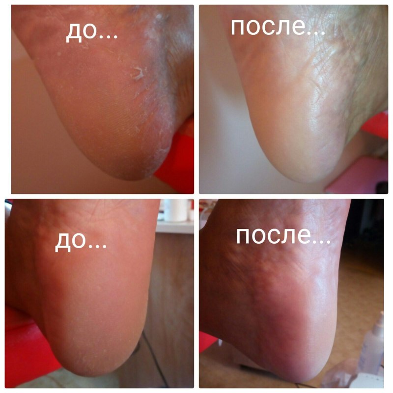Женский педикюр до и после