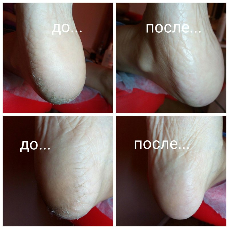 Педикюр Голден Трейс до после