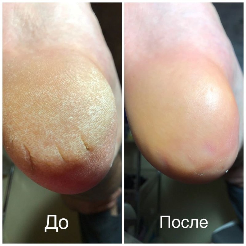 Аппаратный педикюр Голден Трейс