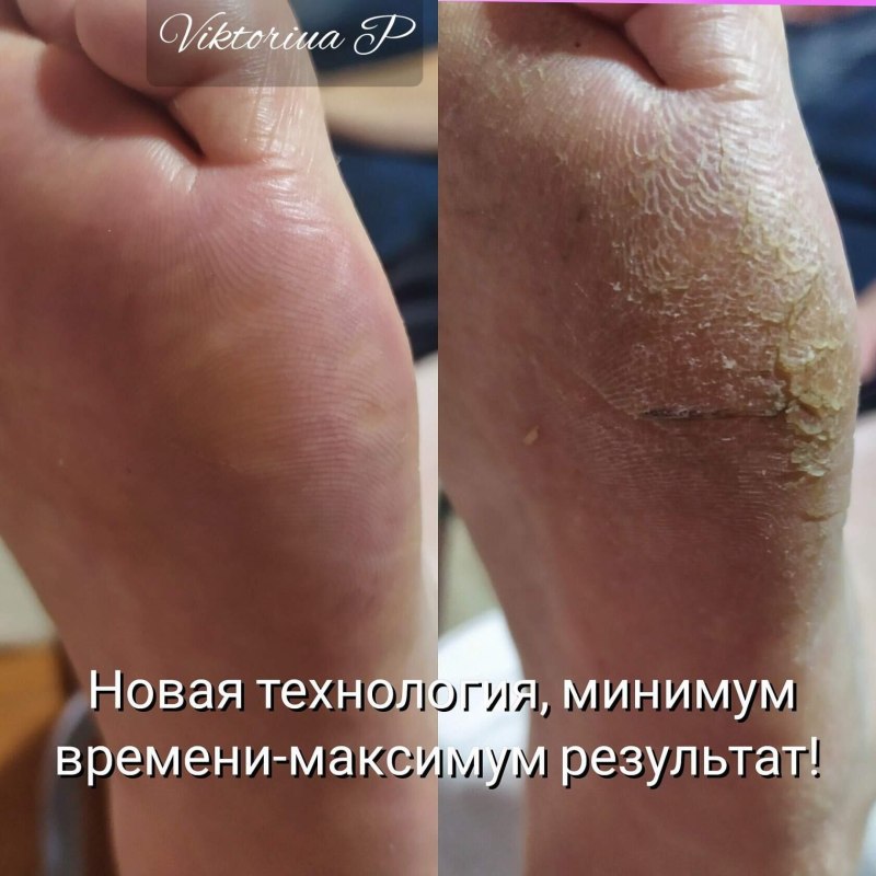 Аппаратный педикюр смарт дисками