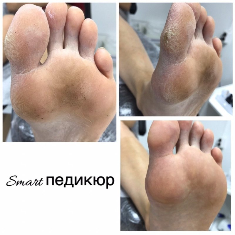 Аппаратный педикюр до и после