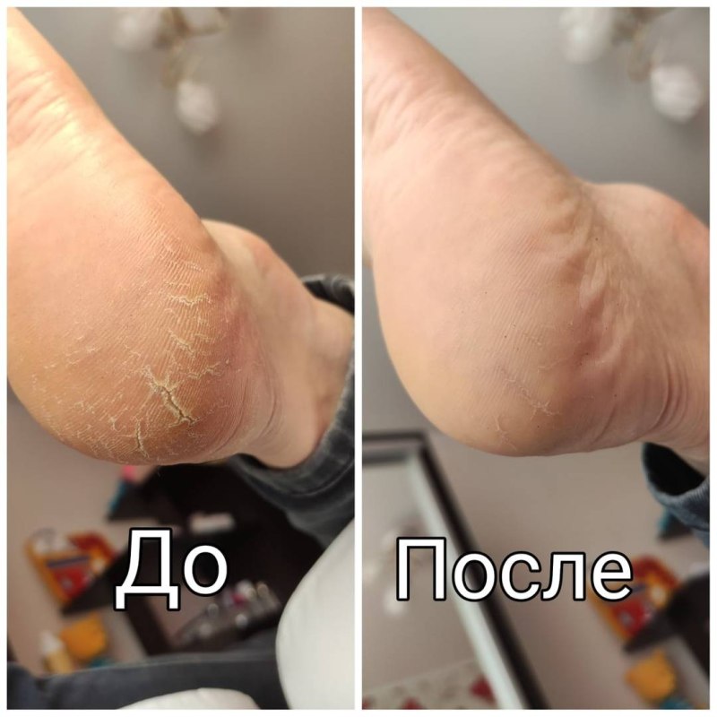 Педикюр отросшие ногти