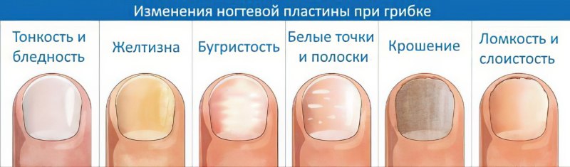 Онихомикоз — грибковое поражение ногтей.