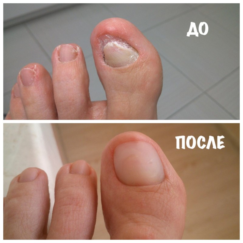 Обстриженные ногти с ног