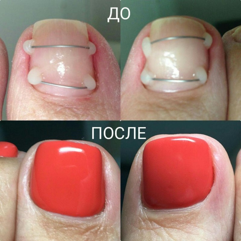 Форма ногтей для педикюра как сделать
