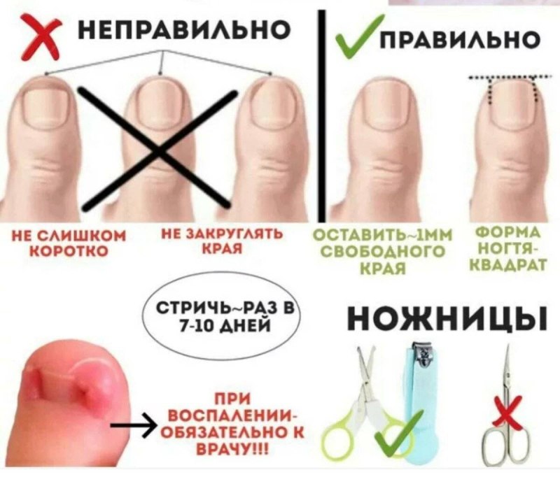 Типы поражения ногтевой пластины