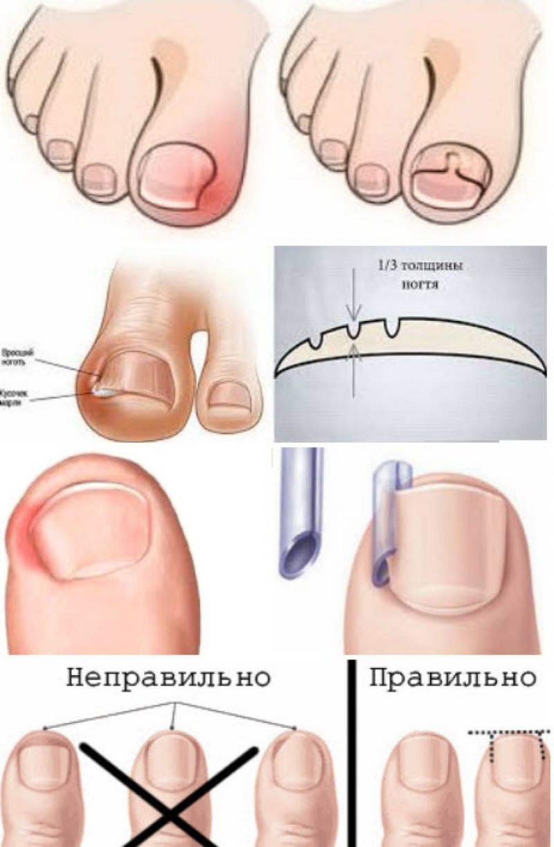 Как правильно стричь ногти младенцу